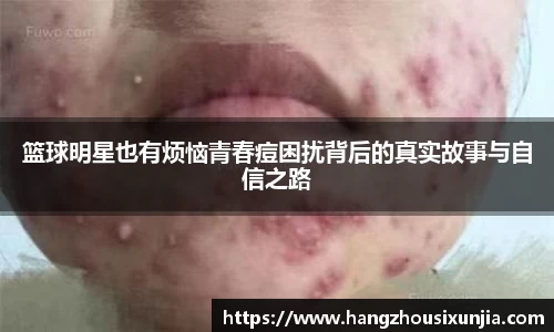 篮球明星也有烦恼青春痘困扰背后的真实故事与自信之路
